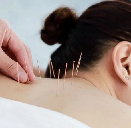 Acupuncture treatment
