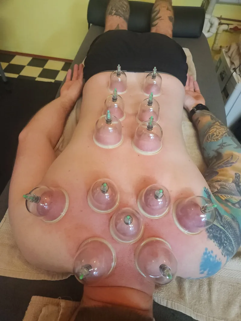 Cupping therapy