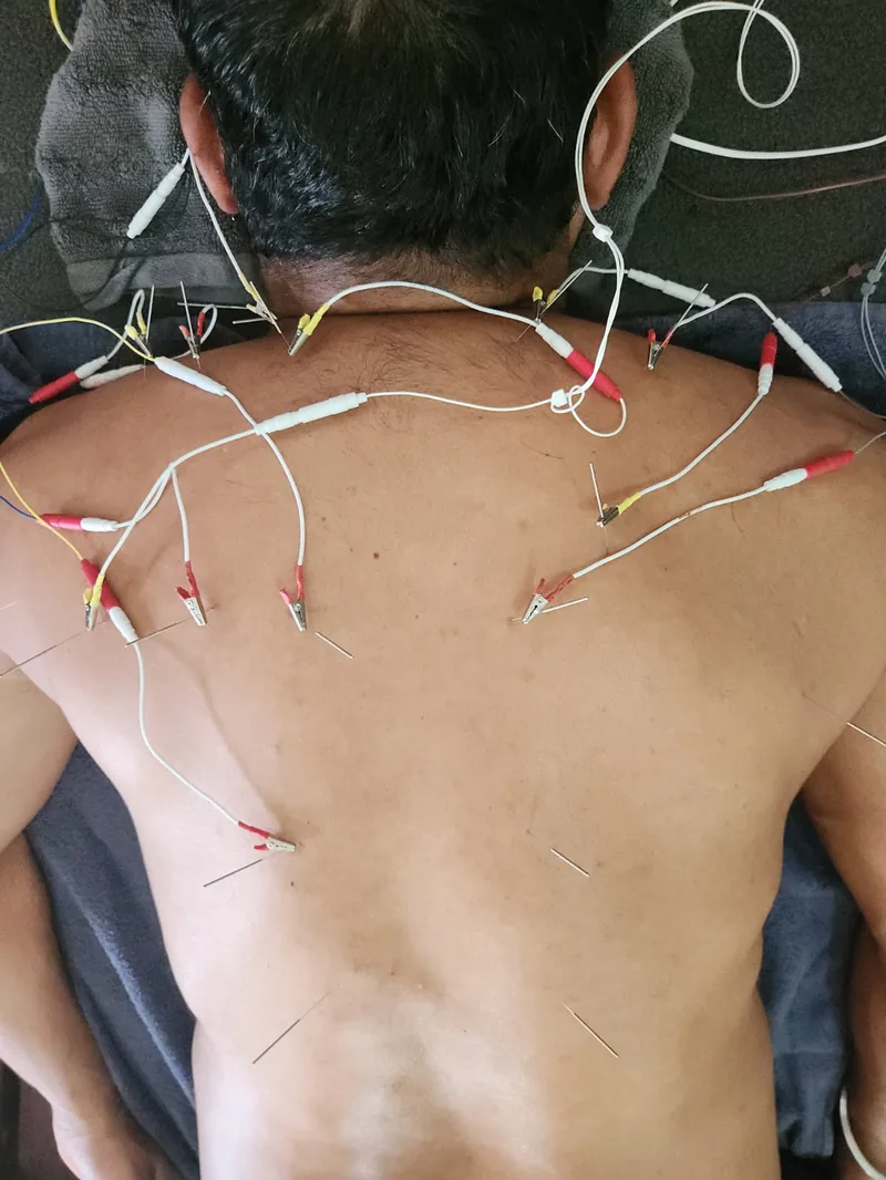 Electro-acupuncture treatment